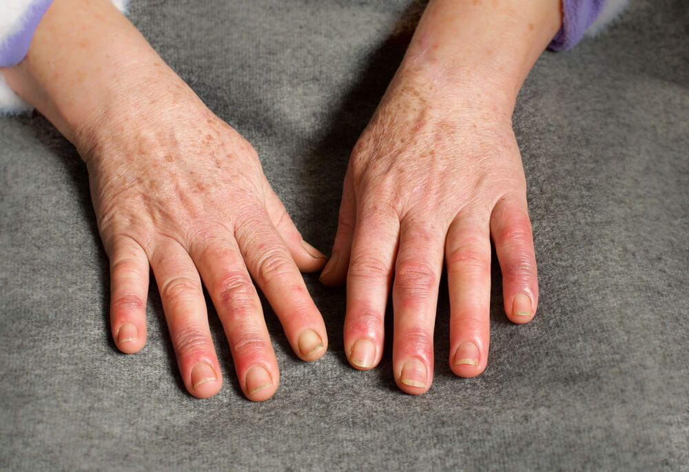 Why are my fingers swollen and sore? shutterstock 1760197094 why are my fingers swollen