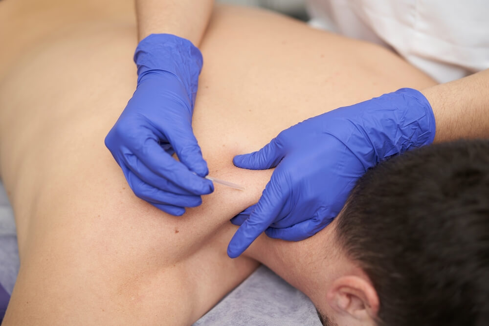 What are some benefits of trying dry needling near me?